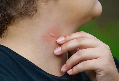 Gerötete und geschwollene Einstichstelle am Hals einer Person, die die betroffene Hautstelle mit der Hand berührt.